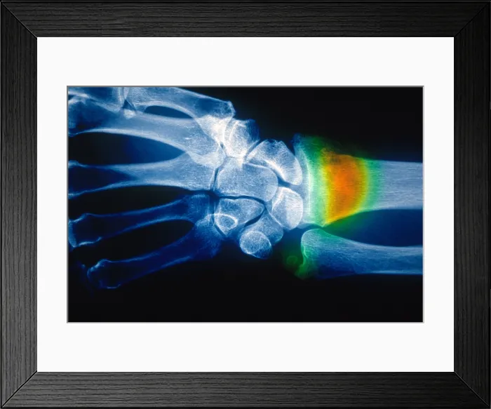 Framed Print : Colles Fracture, X-ray
