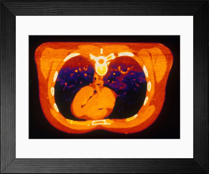 Framed Print : Chest & Heart, CT Scan Framed Print : Chest & Heart, CT Scan