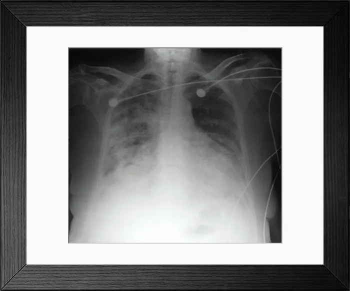 Framed Print : CXR congestive heart failure 77 year old woman Framed Print : CXR congestive heart failure 77 year old woman