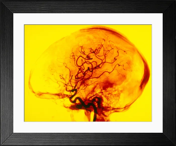 Framed Print : Cerebral Angiogram Framed Print : Cerebral Angiogram