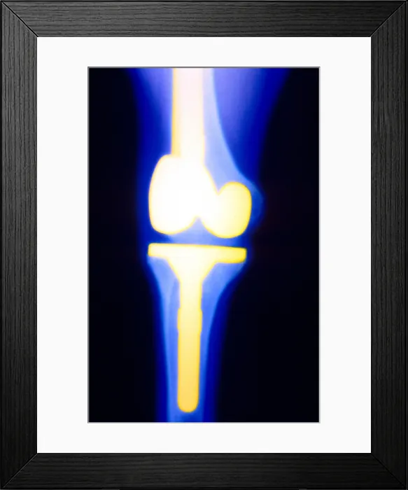 Framed Print : Knee replacement x-ray of a 38 year old female Framed Print : Knee replacement x-ray of a 38 year old female