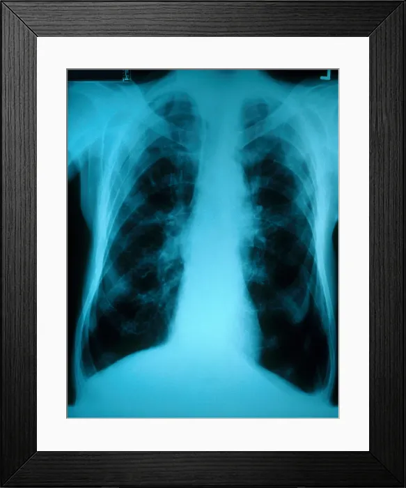 Framed Print : Chronic Obstructive Pulmonary Disease (X-ray) Framed Print : Chronic Obstructive Pulmonary Disease (X-ray)