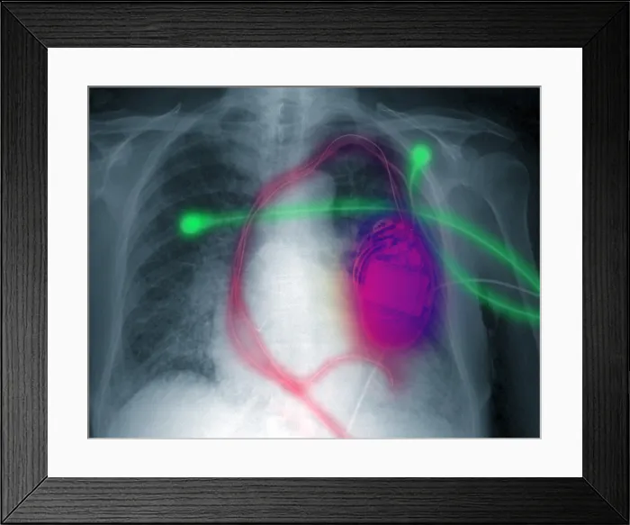 Framed Print : Pacemaker Defibrillator Framed Print : Pacemaker Defibrillator