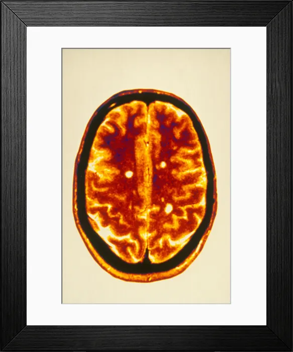 Framed Print : MRI Multiple Sclerosis