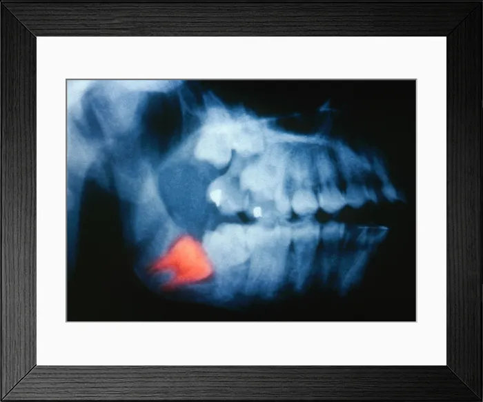 Framed Print : Impacted Wisdom Tooth, X-ray Framed Print : Impacted Wisdom Tooth, X-ray