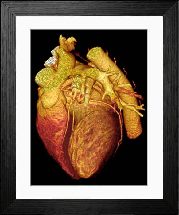 Framed Print : CT Scan, Heart Framed Print : CT Scan, Heart