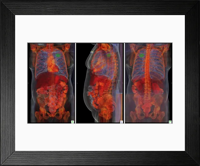 Framed Print : Lung Cancer, 3D CT Scan Framed Print : Lung Cancer, 3D CT Scan
