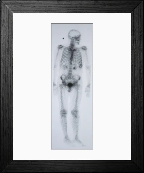 Framed Print : Chondrosarcoma Framed Print : Chondrosarcoma