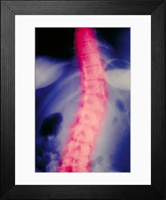 Framed Print : X-Ray. Scoliosis of spine Framed Print : X-Ray. Scoliosis of spine