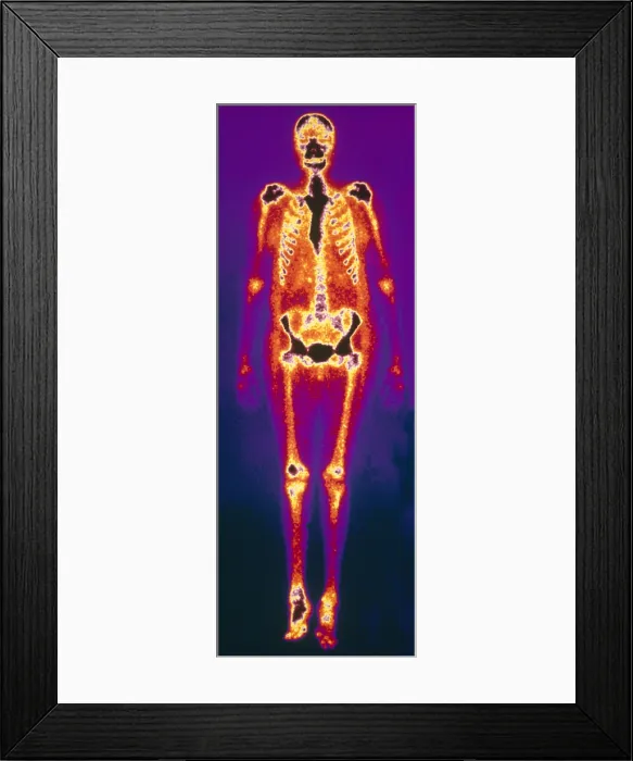 Framed Print : Osteomyelitis Framed Print : Osteomyelitis