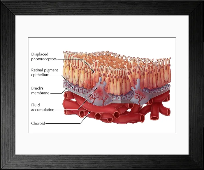 Framed Print : Wet AMD, Illustration Framed Print : Wet AMD, Illustration