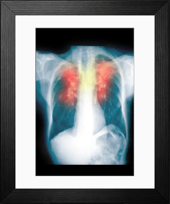 Framed Print : Chest x-ray showing silicosis Framed Print : Chest x-ray showing silicosis