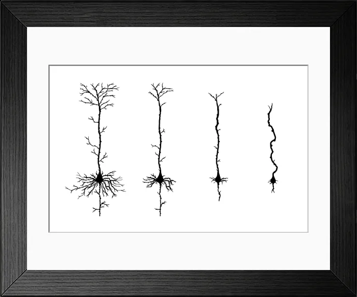 Framed Print : Alzheimer's Disease, Neuron Degeneration Framed Print : Alzheimer's Disease, Neuron Degeneration