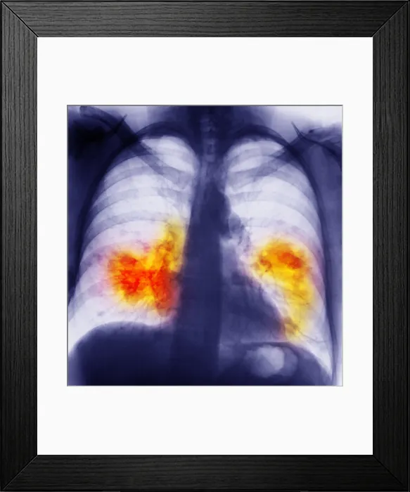 Framed Print : Lung Cancer Framed Print : Lung Cancer