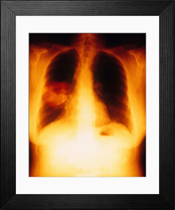 Framed Print : Squamous Cell Carcinoma, Lungs, X-ray