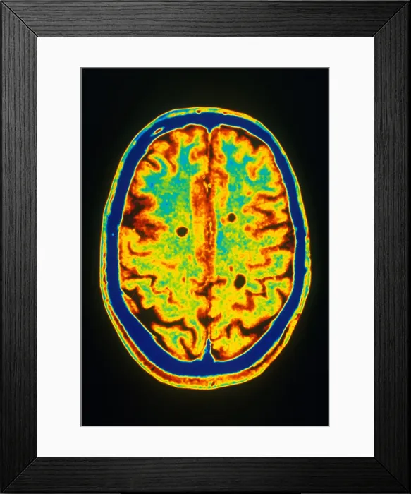 Framed Print : MRI Multiple Sclerosis Framed Print : MRI Multiple Sclerosis