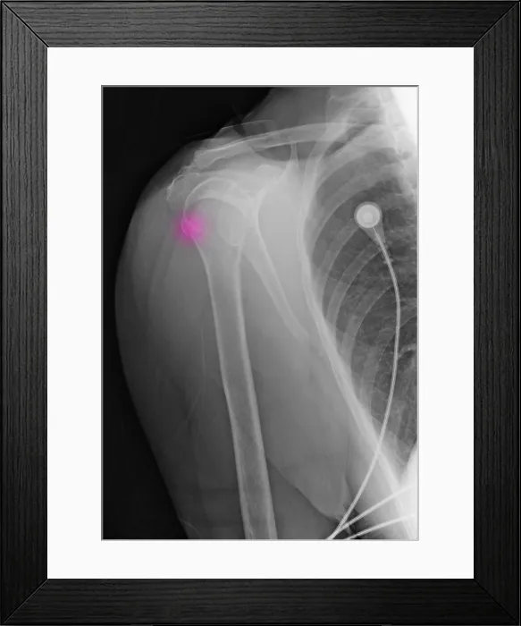 Framed Print : Upper Humerus Fracture, Osteoporosis Framed Print : Upper Humerus Fracture, Osteoporosis