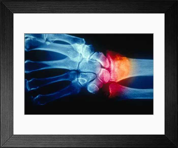 Framed Print : Colles Fracture, X-ray
