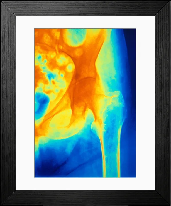 Framed Print : Osteoporosis of the Hip, X-ray Framed Print : Osteoporosis of the Hip, X-ray