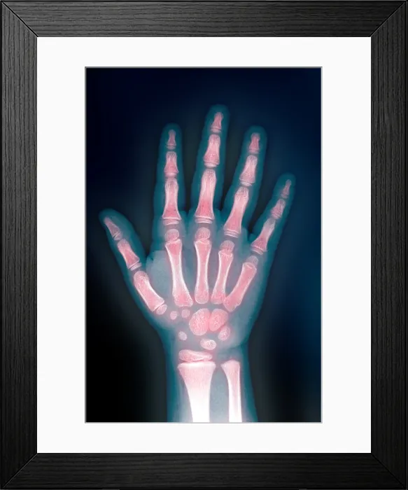 Framed Print : X-ray of hand Framed Print : X-ray of hand