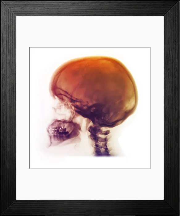 Framed Print : Skull of Healthy 42 Year Old Woman