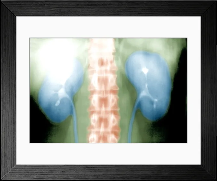 Framed Print : Intravenous pyelogram (IVP)