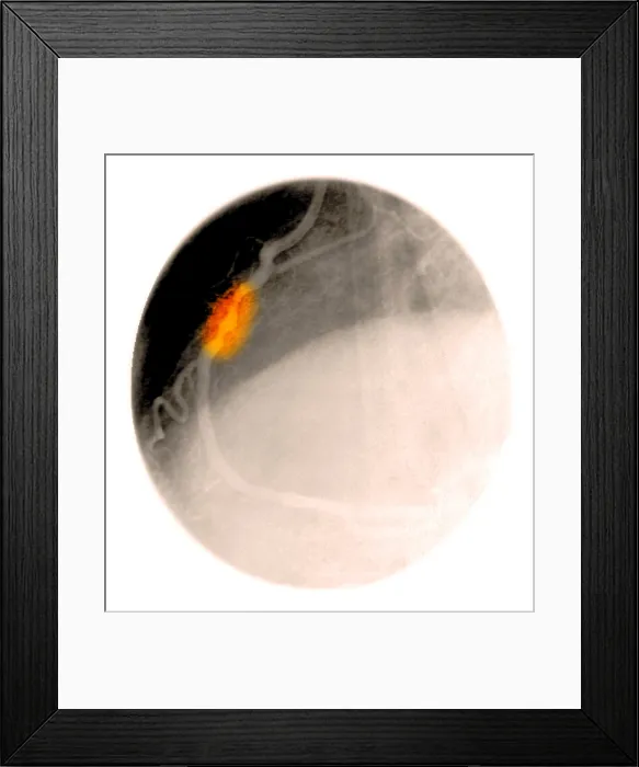 Framed Print : Angiogram of a blocked coronary artery Framed Print : Angiogram of a blocked coronary artery