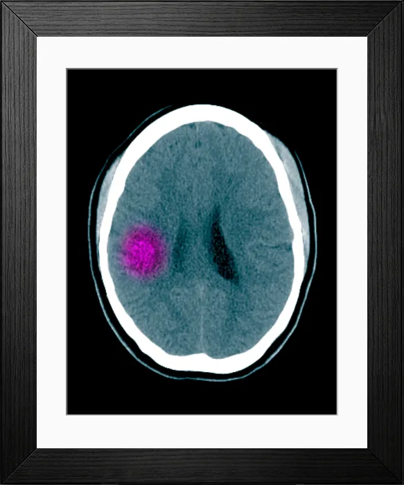 Framed Print : Lyme Disease Framed Print : Lyme Disease