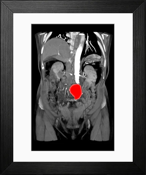 Framed Print : CT Scan of Abdominal Aortic Aneurysm