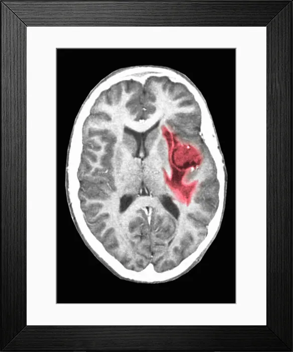 Framed Print : Glioma brain tumor Framed Print : Glioma brain tumor
