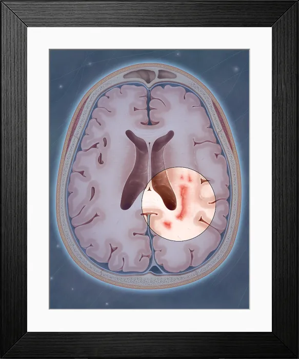 Framed Print : Multiple Sclerosis Framed Print : Multiple Sclerosis