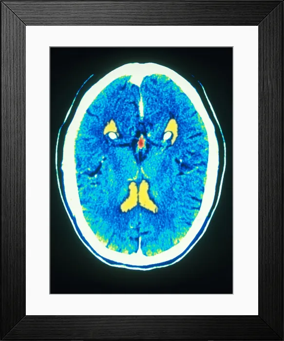 Framed Print : Brain, CT Scan