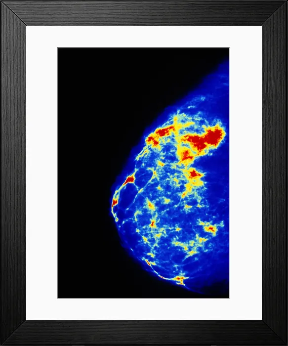 Framed Print : Breast cancer Framed Print : Breast cancer