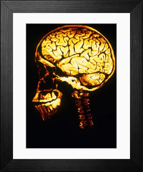 Framed Print : Skull With Brain Framed Print : Skull With Brain