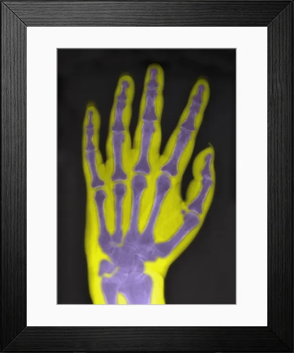 Framed Print : X-Ray Showing Severe Osteoporosis Framed Print : X-Ray Showing Severe Osteoporosis