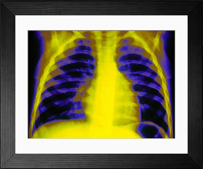 Framed Print : Chest X-ray Framed Print : Chest X-ray