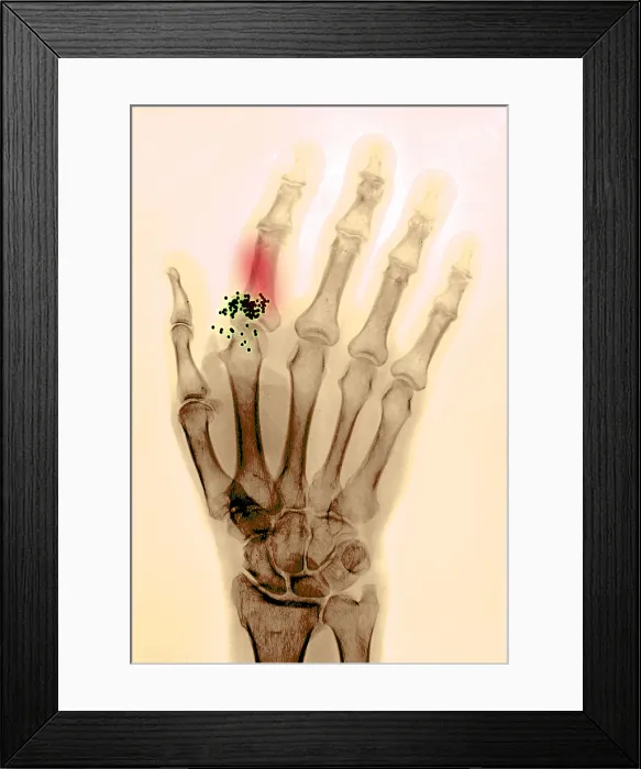 Framed Print : Hand x-ray showing shotgun wound Framed Print : Hand x-ray showing shotgun wound