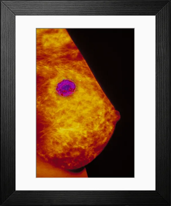Framed Print : Breast cancer Framed Print : Breast cancer