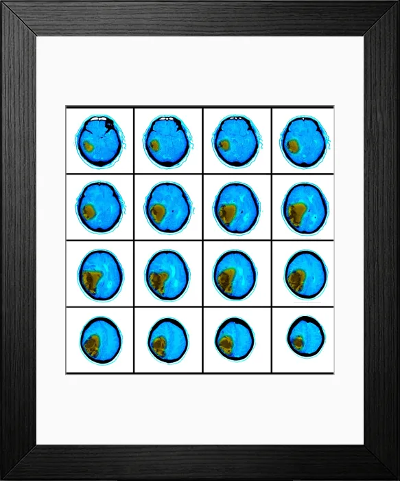 Framed Print : Hemorrhagic Stroke