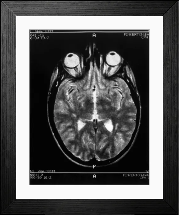 Framed Print : Multiple sclerosis Framed Print : Multiple sclerosis