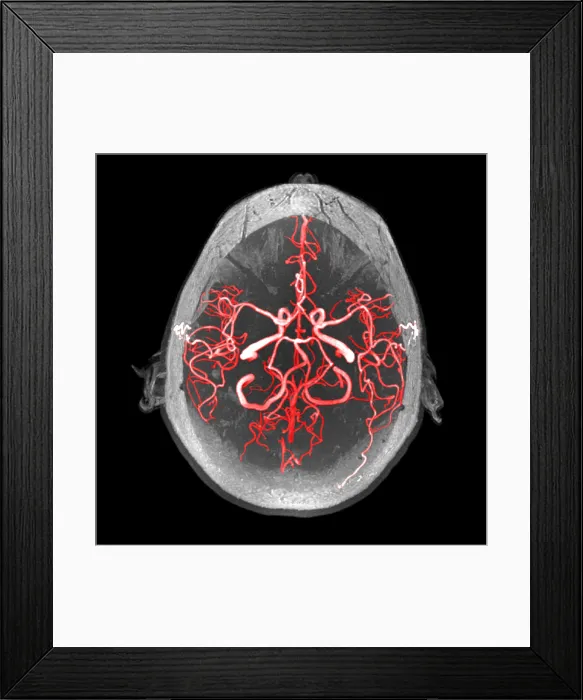 Framed Print : Arteries of the Brain, MRA