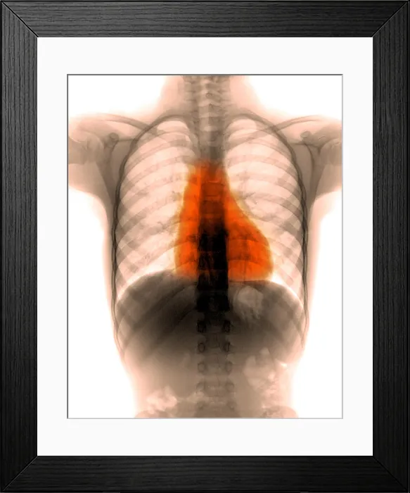 Framed Print : X-ray of thorax and abdomen Framed Print : X-ray of thorax and abdomen