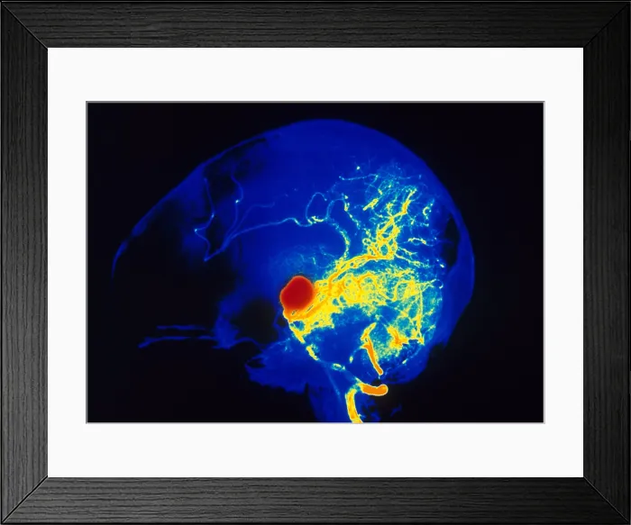 Framed Print : Aneurysm. Cerebral angiogram showing aneurysm of left vertebral artery