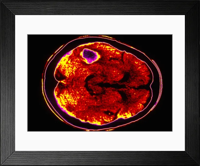 Framed Print : Brain hemorrhage Framed Print : Brain hemorrhage