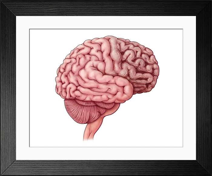 Framed Print : Tay-sachs Disease, illustration Framed Print : Tay-sachs Disease, illustration