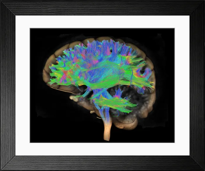 Framed Print : Brain, Fiber Tractography Image Framed Print : Brain, Fiber Tractography Image