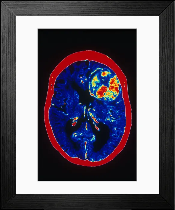 Framed Print : Brain Cancer, CT Scan Framed Print : Brain Cancer, CT Scan