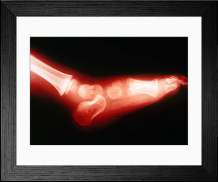 Framed Print : 2 Year Old's Foot, X-ray