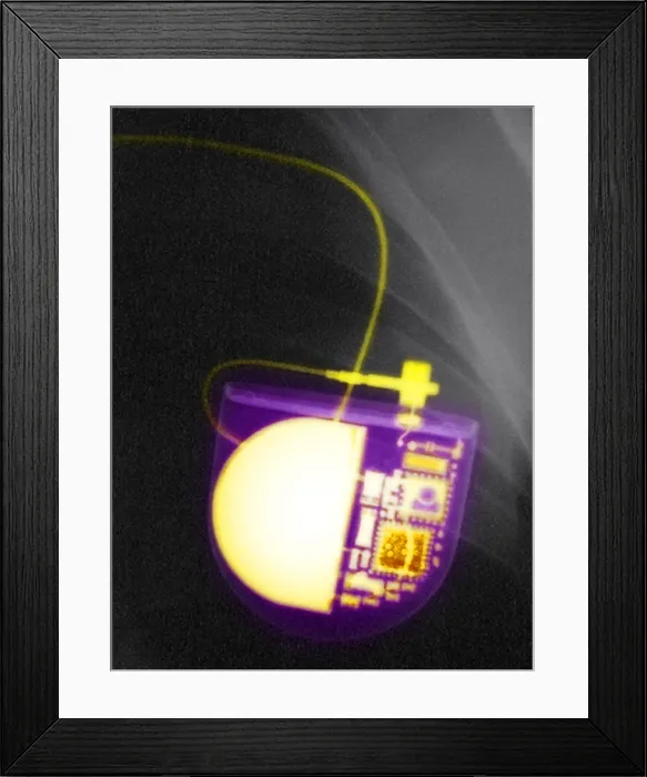 Framed Print : Pacemaker. Color enhanced x-ray of a pacemaker placed in a Bolivian patient Framed Print : Pacemaker. Color enhanced x-ray of a pacemaker placed in a Bolivian patient