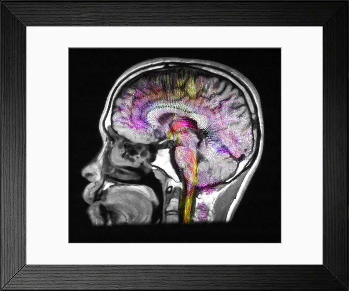 Framed Print : Normal Brain, Fiber Tractography and MRI Framed Print : Normal Brain, Fiber Tractography and MRI
